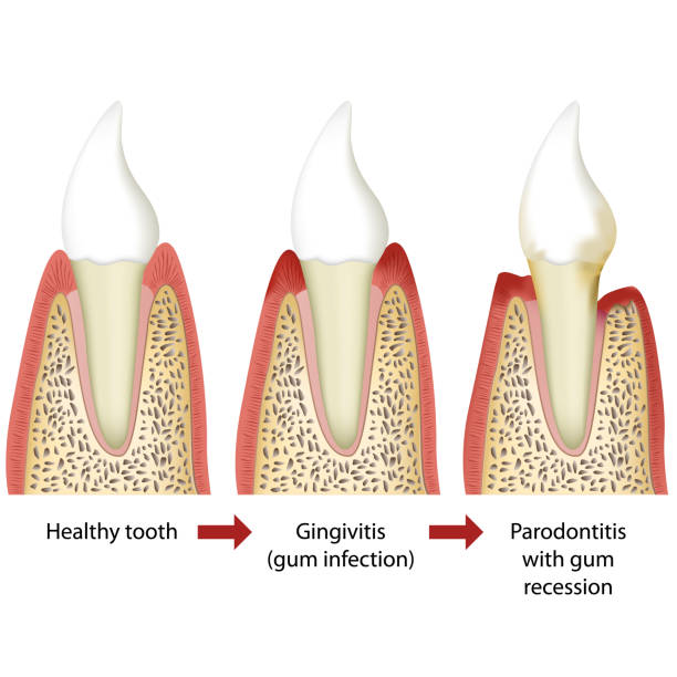 ilustrações de stock, clip art, desenhos animados e ícones de stages of periodontitis medical vector illustration white background - human teeth dental hygiene anatomy diagram