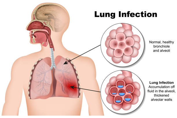 ilustraciones, imágenes clip art, dibujos animados e iconos de stock de neumonía por infección pulmonar ilustración vectorial médica 3d sobre fondo blanco - neumonía