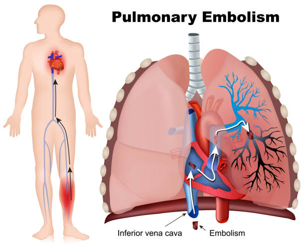 ilustraciones, imágenes clip art, dibujos animados e iconos de stock de ilustración vectorial médica de embolia pulmonar con descripción sobre fondo blanco - coágulo de sangre