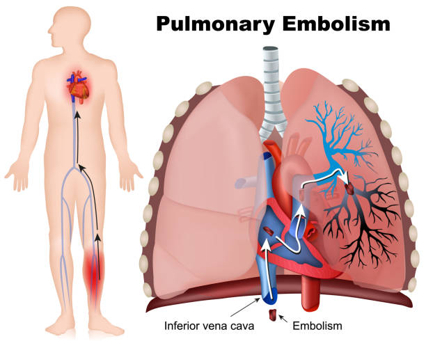 Pulmonary  embolism medical vector illustration with description on white background Pulmonary  embolism medical vector illustration with description on white background eps 10 blood clot stock illustrations