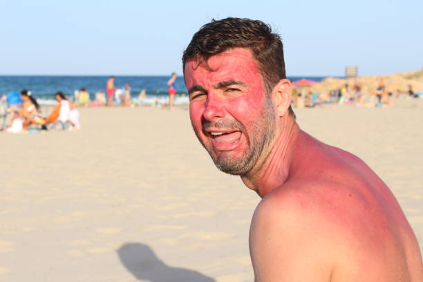 istock Man crying after a long sun exposure 1141409905