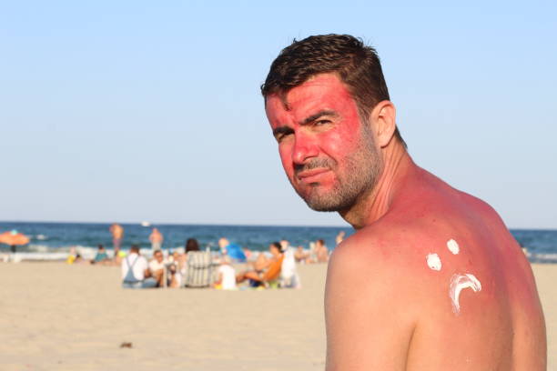 istock Baked man after a long sun exposure 1141409914