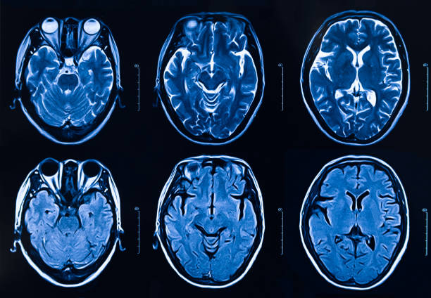 mri scan mänskliga huvudet tomografi - brain scan' bildbanksfoton och bilder