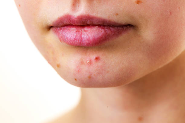 にきびの肌の問題と女性の顔 - chin ストックフォトと画像