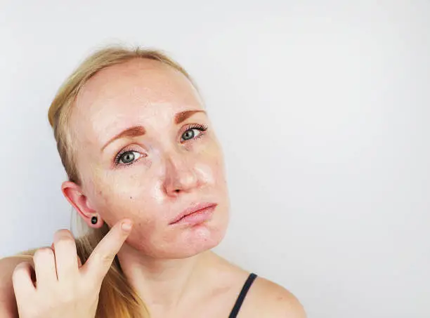 Photo of Oily and problem skin. Portrait of a blonde girl with acne, oily skin and pigmentation