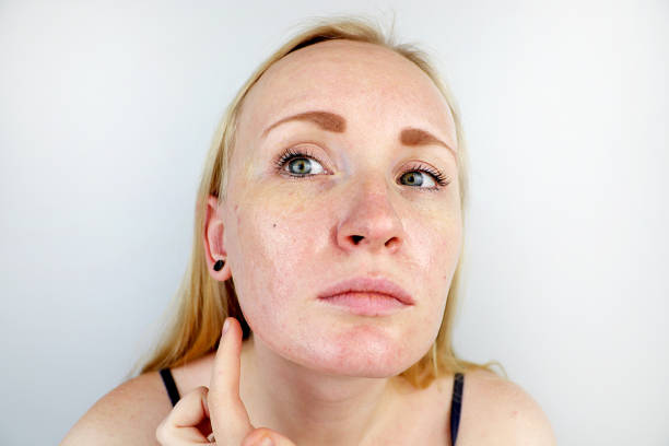 油�性と問題の皮膚。にきび、オイリー肌と色素沈着とブロンドの女の子の肖像 - human skin dry human face peeling ストックフォトと画像
