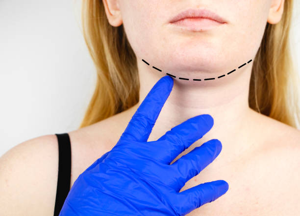 istock Mentoplasty: plastic chin. Patient before chin and neck surgery. Plastic surgeon advises 1141499067