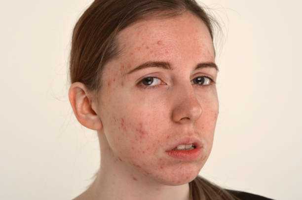 istock beautiful young girl with problematic skin, acne problem concept 1141504853