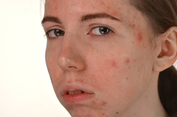 istock beautiful young girl with problematic skin, acne problem concept 1141614748
