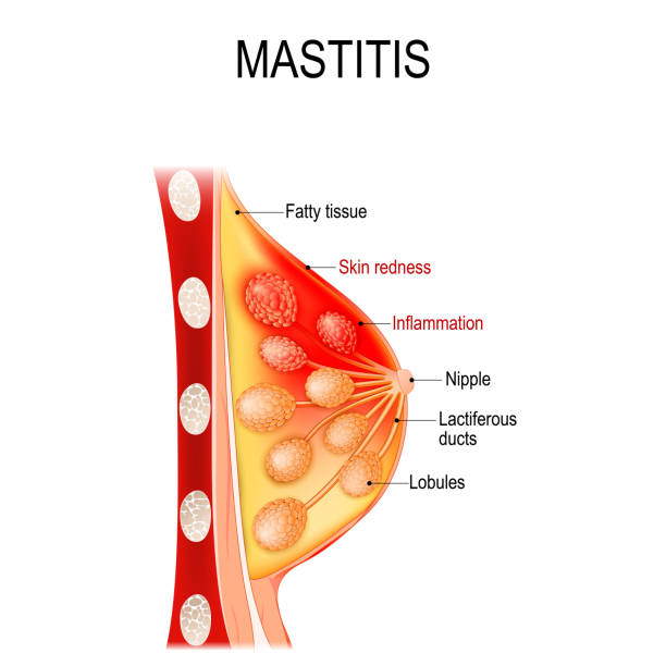 mastitis. querschnitt durch die brustdrüse mit entzündung der brust (abszess bildung). - abszess stock-grafiken, -clipart, -cartoons und -symbole
