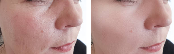 istock face woman wrinkles before and after procedures 1141744884
