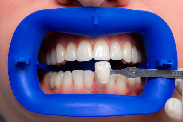 procédure de comparaison des nuances de couleur des dents à l’aide de tests avant le blanchiment - lunettes photos et images de collection