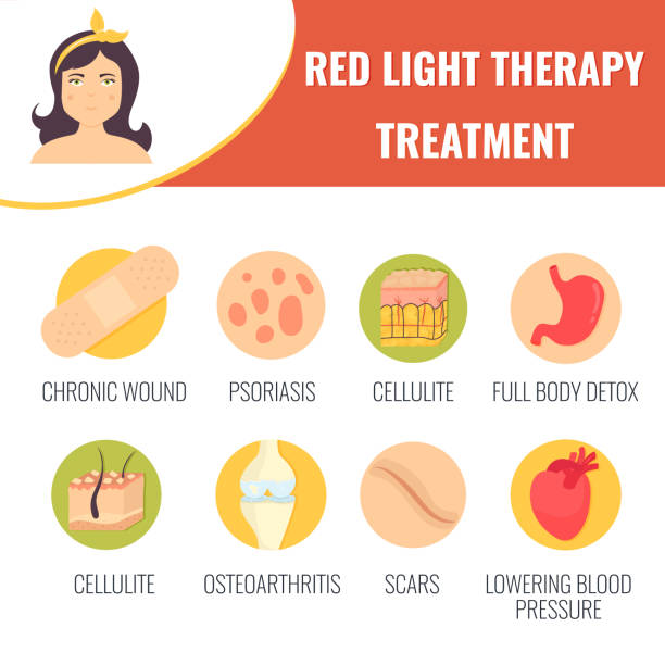 illustrazioni stock, clip art, cartoni animati e icone di tendenza di stimolazione della crescita dei capelli. trattamento di terapia a luci rosse. concetto di cosmetologia. illustrazione vettoriale - laser therapy medical laser light therapy