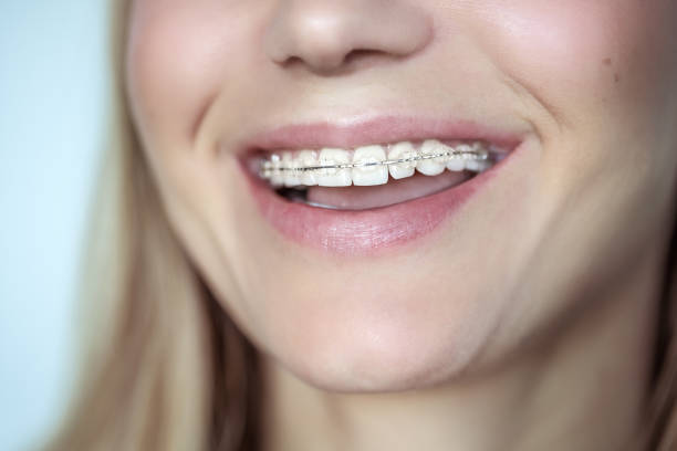 istock Braces, treatment for a crooked teeth 1141946212