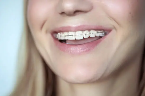 Photo of Braces, treatment for a crooked teeth