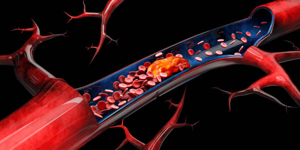 istock 3dIllustration of cerebral sclerosis isolated black background 1141952186