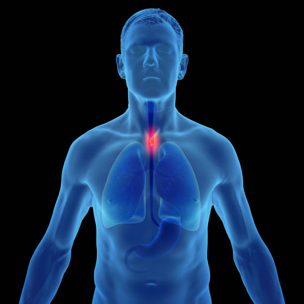 illustrazione 3d del cancro dell'esofago nel maschio umano - dysphagia foto e immagini stock