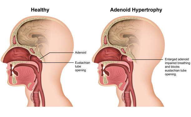 ilustrações de stock, clip art, desenhos animados e ícones de adenoid hypertrophy medical vector illustration on white background - eustachian tube