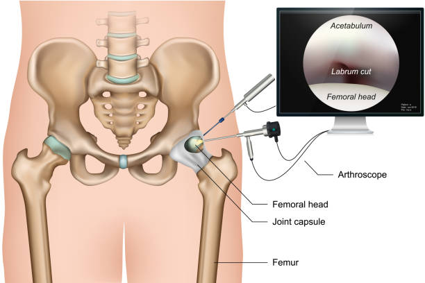 Hip arthroscopy 3d medical vector illustration on white background Hip arthroscopy 3d medical vector illustration on white background eps 10 hip body part stock illustrations