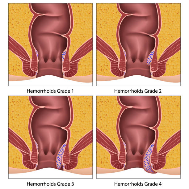 hemoroidy klasy anatomii edukacji informacje graficzne na białym tle - hemorrhoid stock illustrations