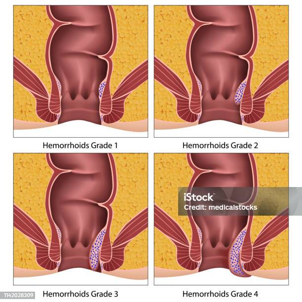 Hemorrhoids Grade Anatomy Education Info Graphic On White Background Stock Illustration - Download Image Now