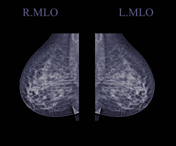 istock X-ray Digital Mammogram  or mammography  both side of the breast  MLO view  for finding Breast cancer in women . Clipping path. 1142345626