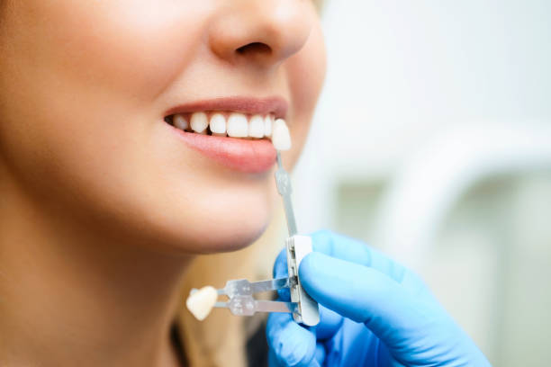 美しい笑顔と若い女性の白い歯。インプラントの色合いや歯のホワイトニングのプロセスを一致させる。 - dental implant dental hygiene dentures prosthetic equipment ストックフォトと画像