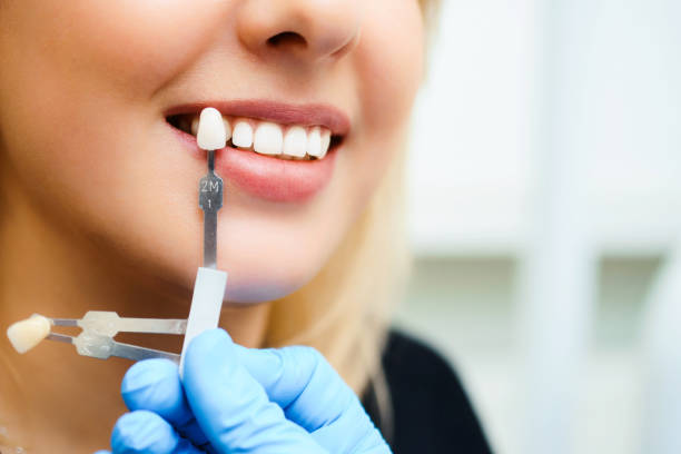 美しい笑顔と若い女性の白い歯。インプラントの色合いや歯のホワイトニングのプロセスを一致��させる。 - dental implant dental hygiene dentures prosthetic equipment ストックフォトと画像