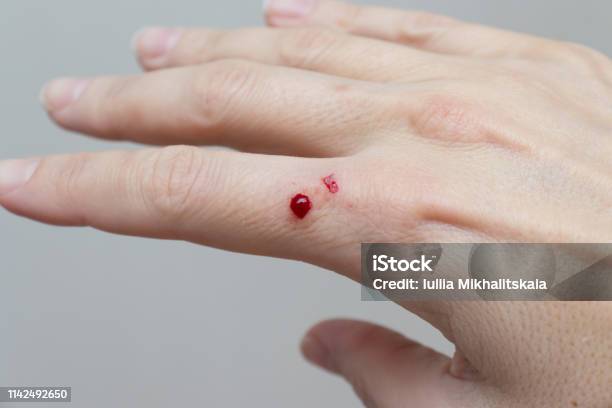 A Bloody Wound On Female Hand Close Up Skin Damage Injury Stock Photo -  Download Image Now - iStock