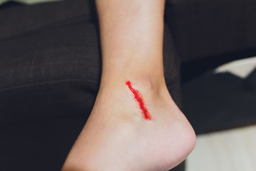 hình ảnh vết thương chảy máu