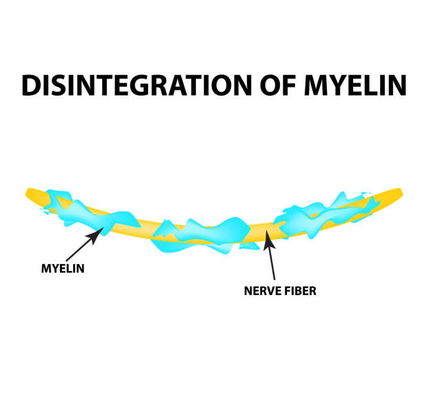 die zerstörung der myelin-hülle auf dem axon. myelin beschädigt. neuron ist von multipler sklerose betroffen. welt-tag der multiplen sklerose. infografiken. vektordarstellung auf isolierten hintergrund. - neuroscience nerve cell nerve fiber dendrite stock-grafiken, -clipart, -cartoons und -symbole