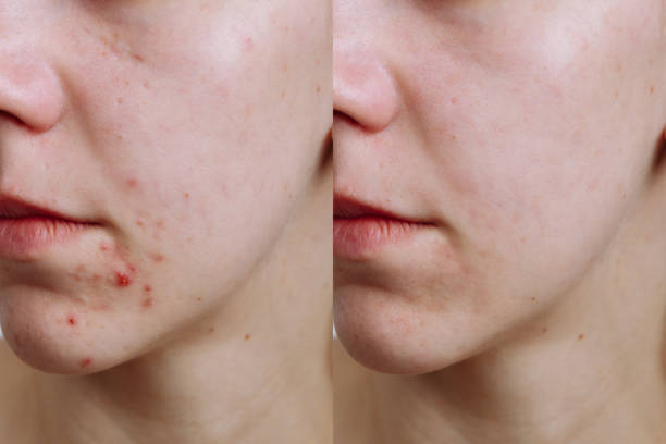 Young woman before and after acne treatment, closeup. Skin care concept Young woman before and after acne treatment, closeup. Skin care concept. before and after photos stock pictures, royalty-free photos & images