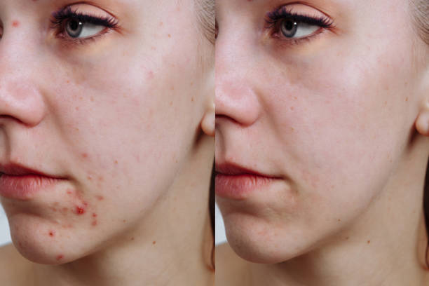 giovane donna prima e dopo il trattamento dell'acne, primo piano. concetto di cura della pelle - dot gain immagine foto e immagini stock