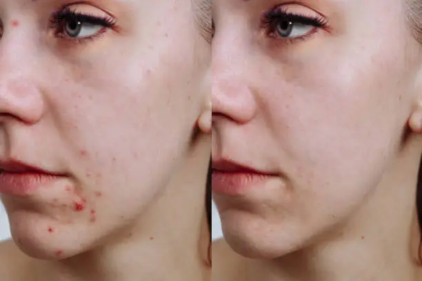 Young woman before and after acne treatment, closeup. Skin care concept.