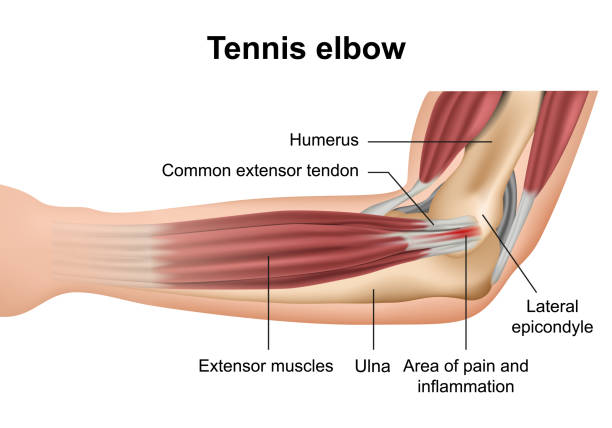 tennis ellbogenverletzung medizinische vektordarstellung auf weißem hintergrund - ellenbogen stock-grafiken, -clipart, -cartoons und -symbole