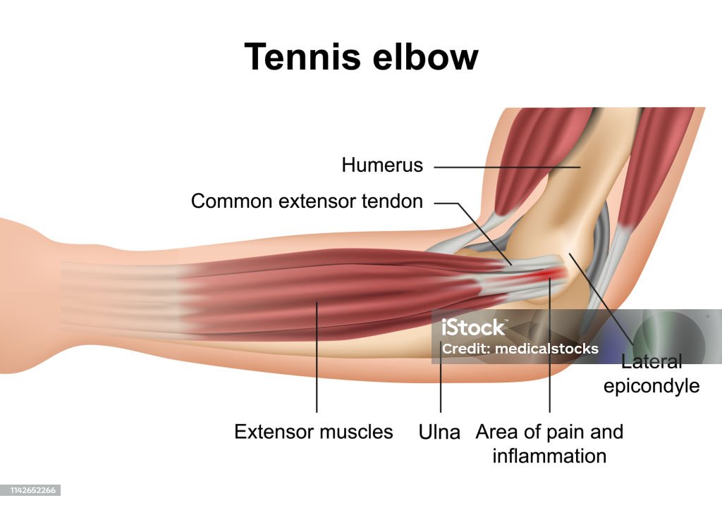 Tennis elbow injury medical vector illustration on white background - Royalty-free Cotovelo arte vetorial