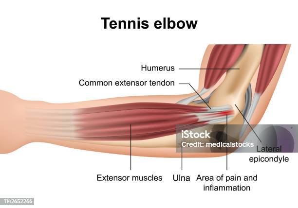Tennis Elbow Injury Medical Vector Illustration On White Background - Arte vetorial de stock e mais imagens de Cotovelo