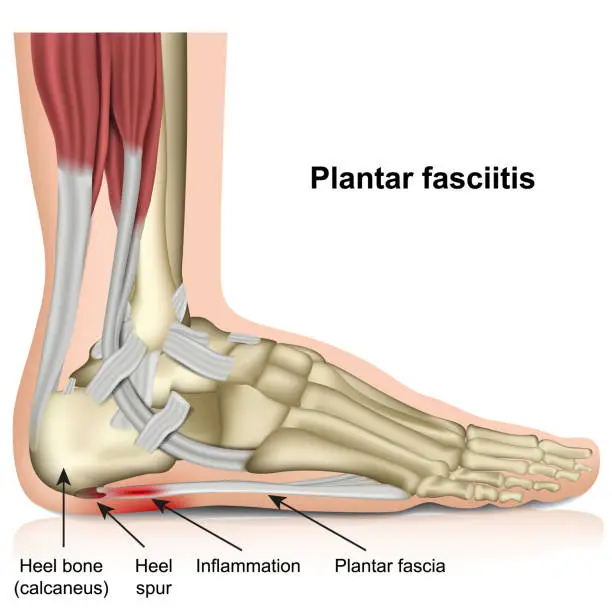 Vector illustration of plantar fasciitis 3d medical vector illustration on white background