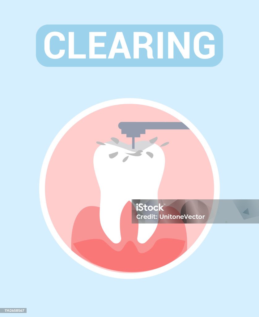 Clearing Tooth Dental Clearing Tooth Drilling Vector Web Banner Stock Illustration ...
