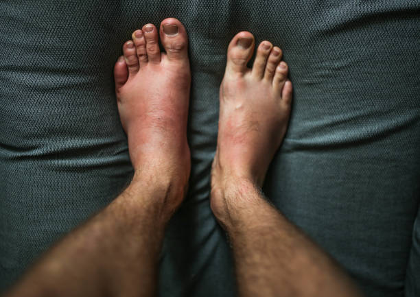 足にアレルギー反応, 腫れつま先.血管 性 浮腫 - angioedema ストックフォトと画像