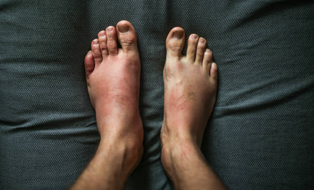 足にアレルギー反応, 腫れつま先.血管 性 浮腫 - angioedema ストックフォトと画像