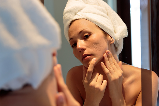 mujer joven mirando sus cicatrices de acné en el espejo photo
