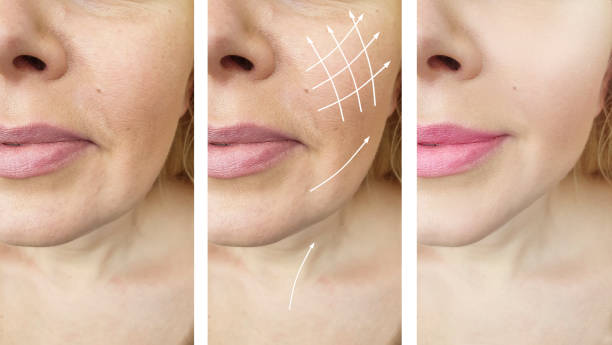 istock woman wrinkles face before and after procedures 1142683971