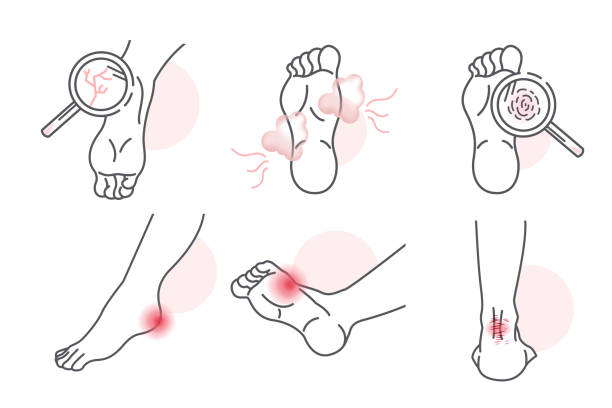 foot skin care problem set kinds of foot skin care problem set tinea stock illustrations