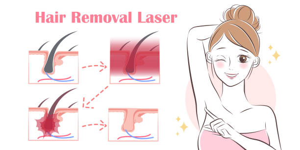 Woman Remove Hair Stock Illustration - Download Image Now - Armpit, Laser,  Under the Arm - iStock