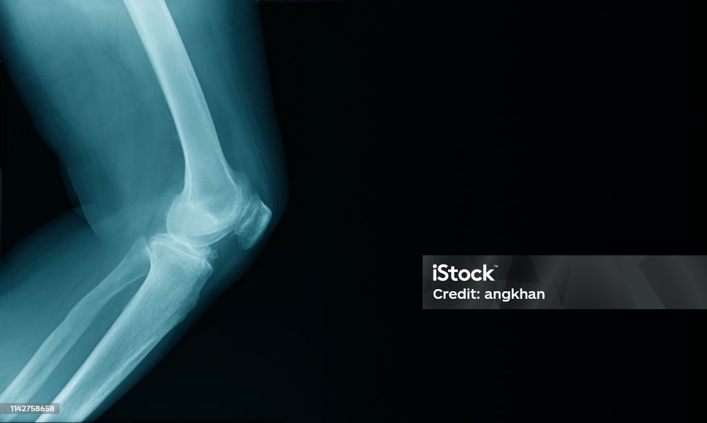 x-ray image de genou OA avec la conception de la bannière - Photo de Anatomie libre de droits