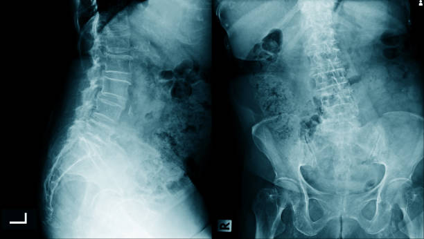 istock lumbar spondylosis x-ray image AP and lateral view 1142758673