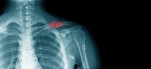 x 線鎖骨骨折, 肩部における老人の事故 - clavicle ストックフォトと画像