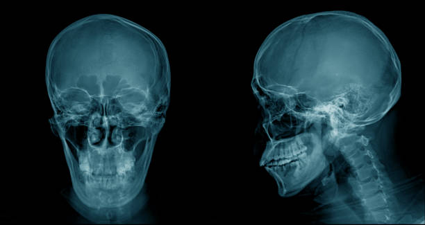 istock skull x-ray image, head injury x-ray for lession dignosis 1142758721