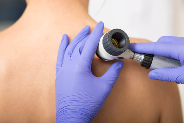 dermatologista inspecionando moles da pele do paciente na clínica - cancer de pele - fotografias e filmes do acervo